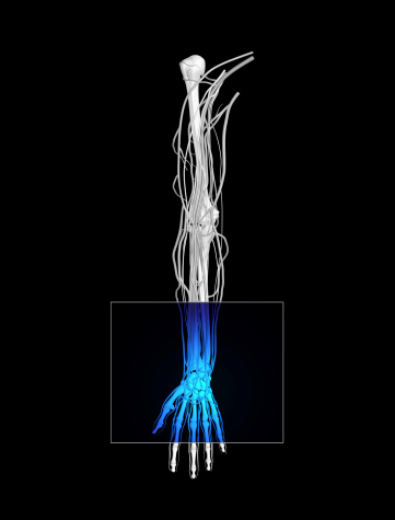 Carpal Tunnel Syndrome