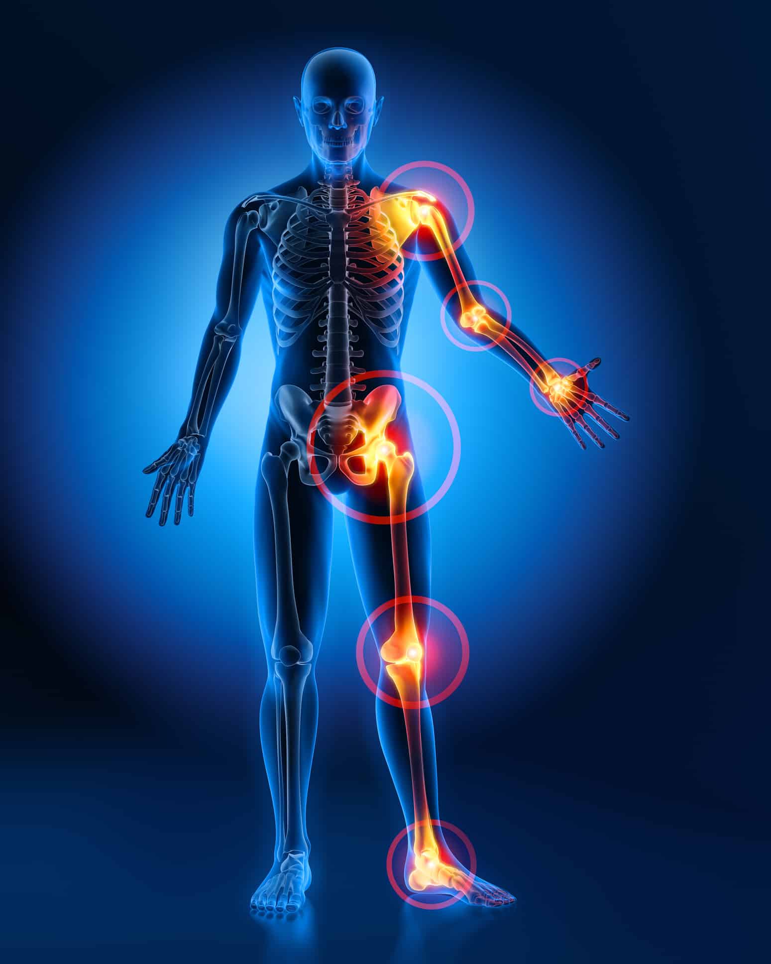 Joint Injections for Osteoarthritis Precautions and Efficacy