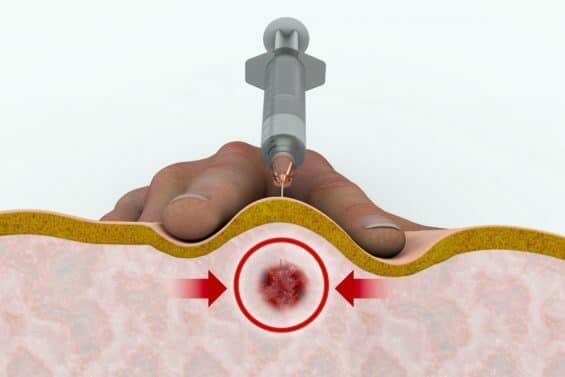 Injections For Back Pain