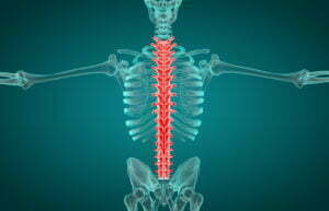 Ankylosing Spondylitis Affecting The Spine